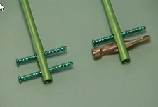 The Distal Femoral Nail from Depuy